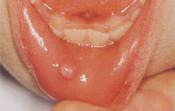 の 中 ない 口 痛く でき もの 唇の中に透明な水ぶくれができる原因／痛くない場合は何なの？