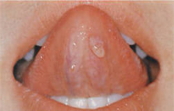子どもの口の中の病気 お母さんのための病気の知識 歯 舌 唇